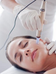 Microneedling gelaat